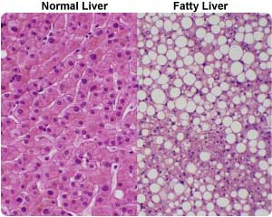 fatty-liver-disease